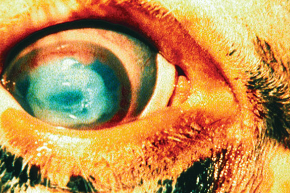 A cattle’s pinkeye in the second stages of infection.